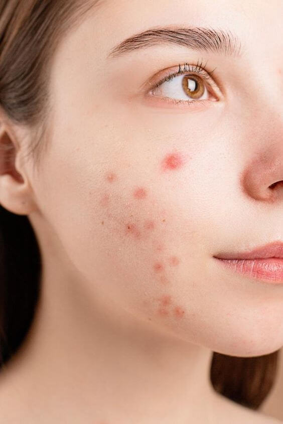 Muitos ainda tem dúvidas. A acne pode ser causada por estresse? Veja bem, a resposta é um grande e sonoro: SIM!